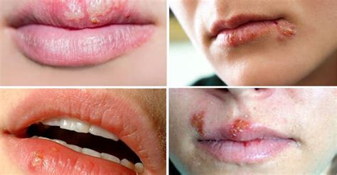 herpes labial en la boca